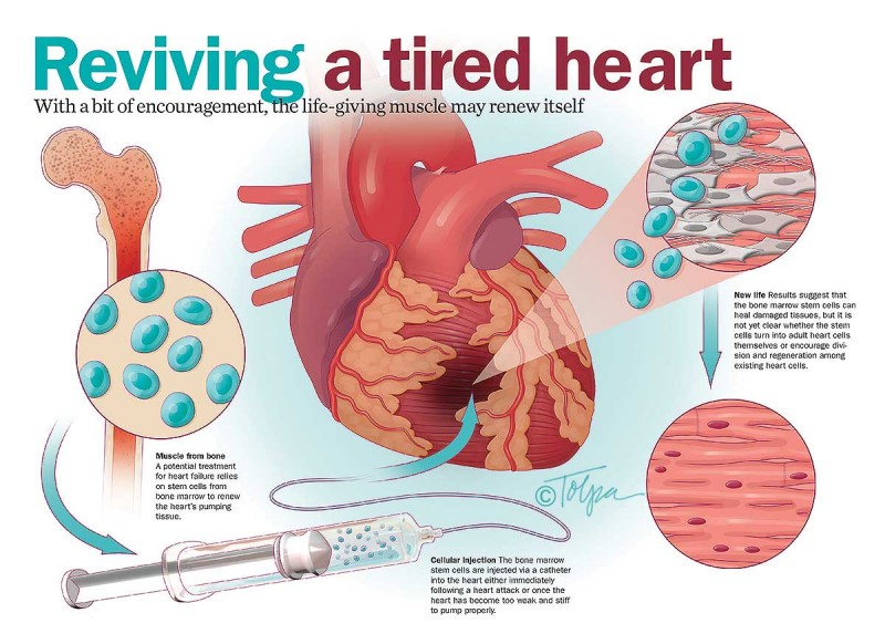 An infographic on the use of stem cells to help an ailing heart.