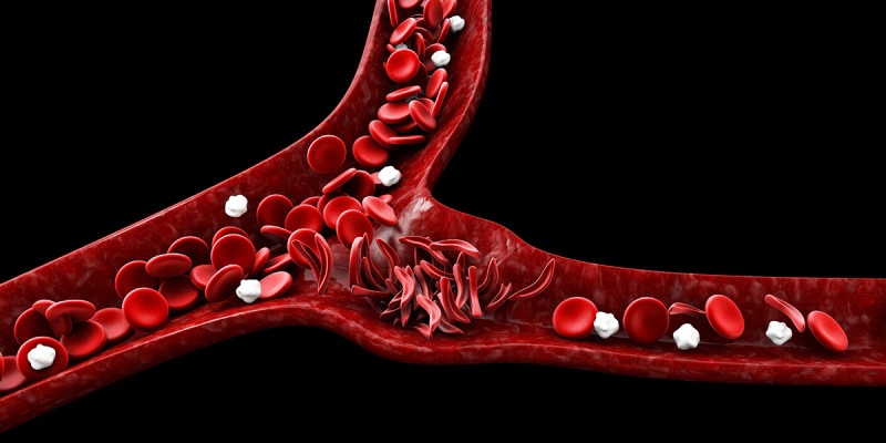 In Sickle Cell Disease, red blood cells are sickle- or crescent-shaped and are more rigid, viscous, and prone to aggregation. The sickle cells are shown in the center, with normal red blood cells depicted on the left and right.