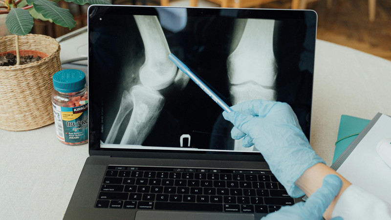 Nearly 800,000 total knee replacements are done every year in the U.S.