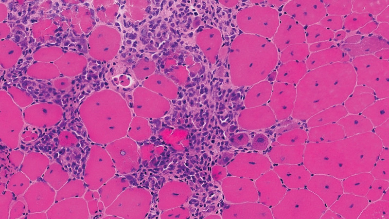 Microscopic cross-section view of dystrophin-deficient muscle tissue shows extensive replacement of muscle fibers by inflammatory adipose cells. DMD is the most common hereditary neuromuscular disease and does not exhibit a predilection for any race or ethnic group. Mutations in the dystrophin gene lead to progressive muscle fiber degeneration and weakness.