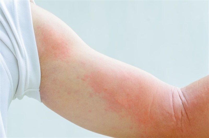 A new study from the Binghamton University looks at the root causes of eczema, also known as atopic dermititis.