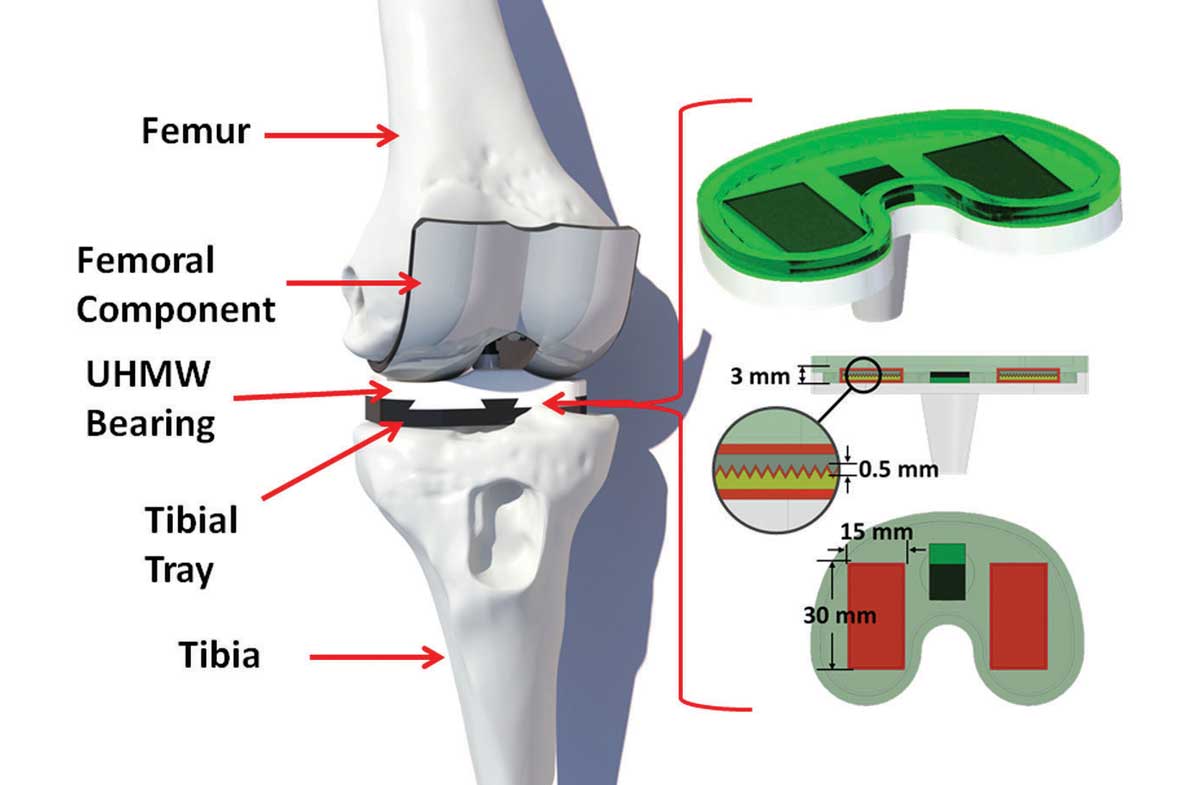 A knee replacement with a built-in sensor can help track wear and tear on the joint.