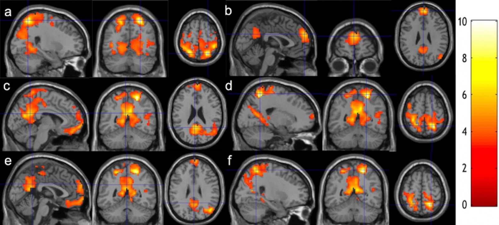 Researchers at Binghamton University scanned students' brains before and after eight weeks of meditation training.