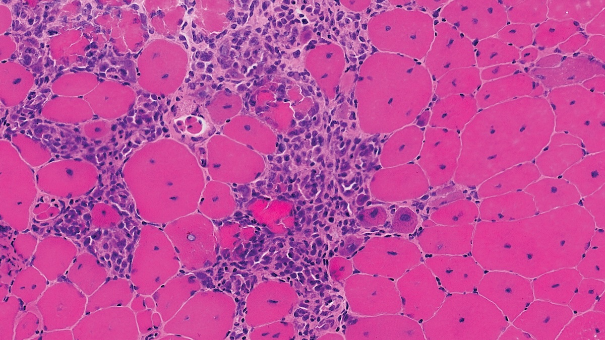 Microscopic cross-section view of dystrophin-deficient muscle tissue shows extensive replacement of muscle fibers by inflammatory adipose cells. DMD is the most common hereditary neuromuscular disease and does not exhibit a predilection for any race or ethnic group. Mutations in the dystrophin gene lead to progressive muscle fiber degeneration and weakness.
